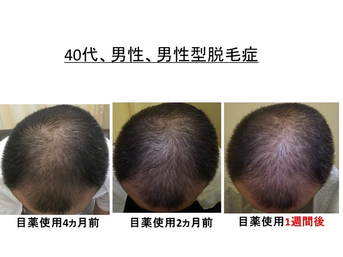 円形脱毛症　病院